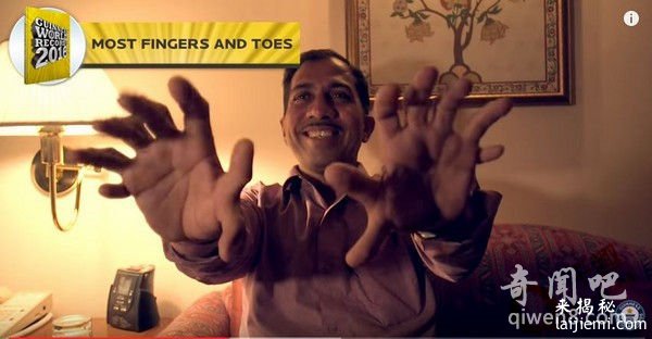 男子天生28指创纪录 拥有手指脚趾最多的人