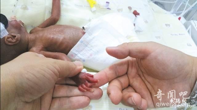1斤1两：史上最小的婴儿 仅比成人手掌大一点